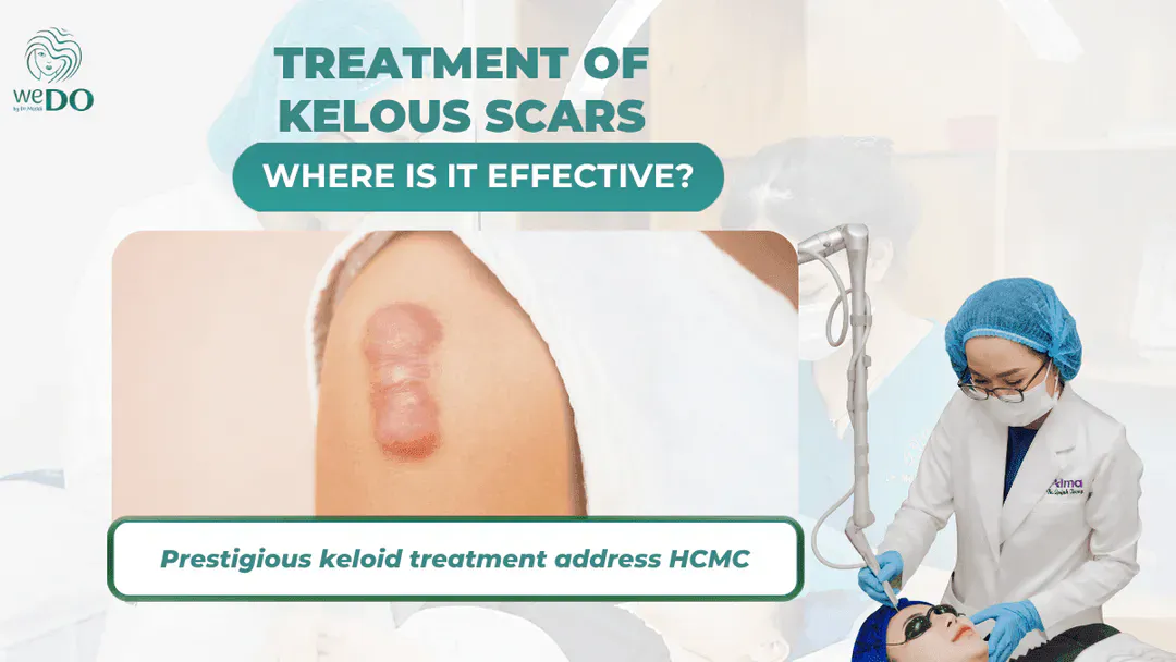 Where is the effective treatment for keloid scars? Reputable keloid scar treatment address in Ho Chi Minh City