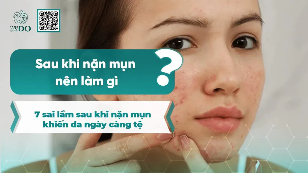 Sau khi nặn mụn nên làm gì? 7 sai lầm sau khi nặn mụn khiến da ngày càng tệ