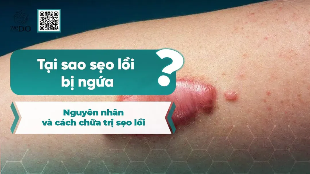 Tại sao sẹo lồi ngứa? Nguyên nhân và cách chữa trị sẹo lồi