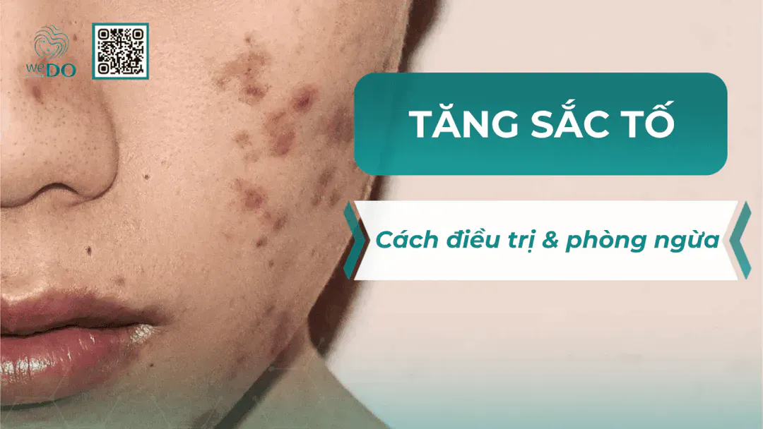Cách điều trị và phòng ngừa tăng sắc tố sau điều trị sẹo