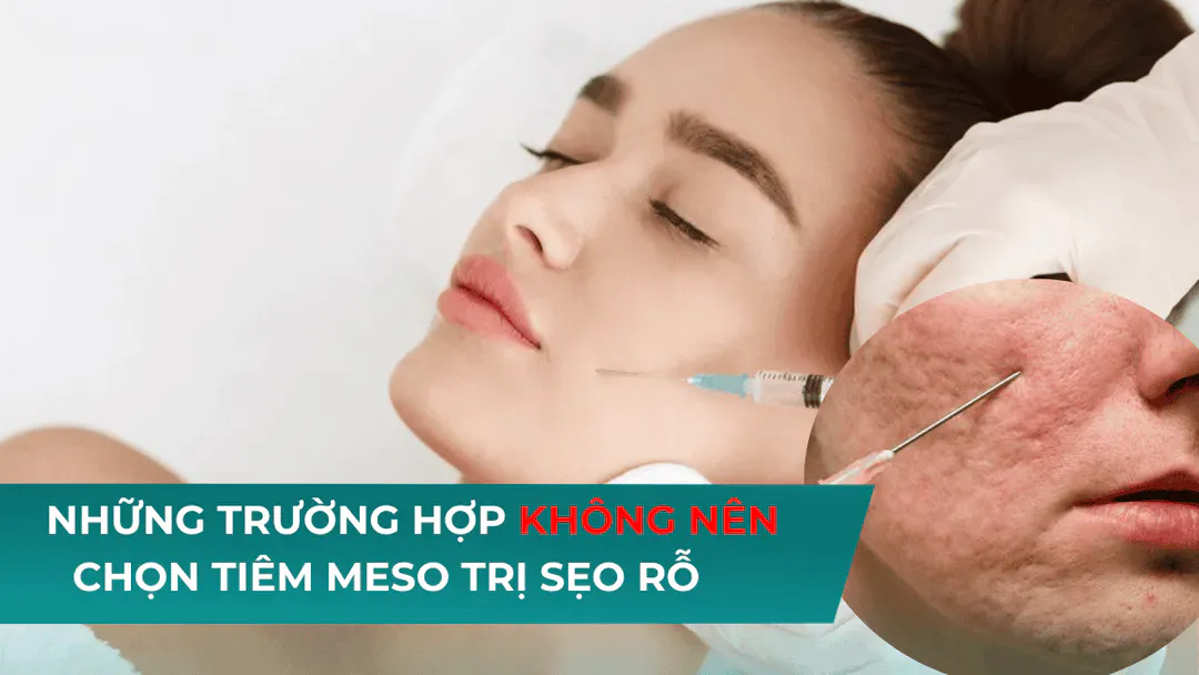 Khi nào không nên chọn phương pháp Mesotherapy điều trị sẹo rỗ?