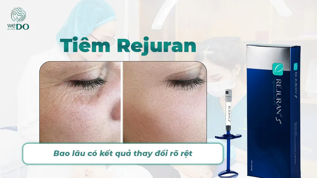 Tiêm Rejuran bao lâu có kết quả thay đổi rõ rệt?