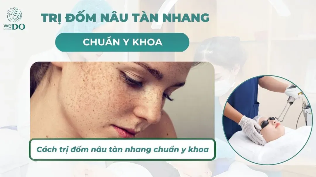 Trị tàn nhang bằng laser tại WeDo Skin Clinic