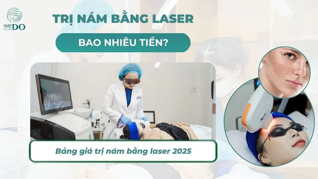 Trị nám bằng laser bao nhiêu tiền? Bảng giá trị nám bằng laser 2026