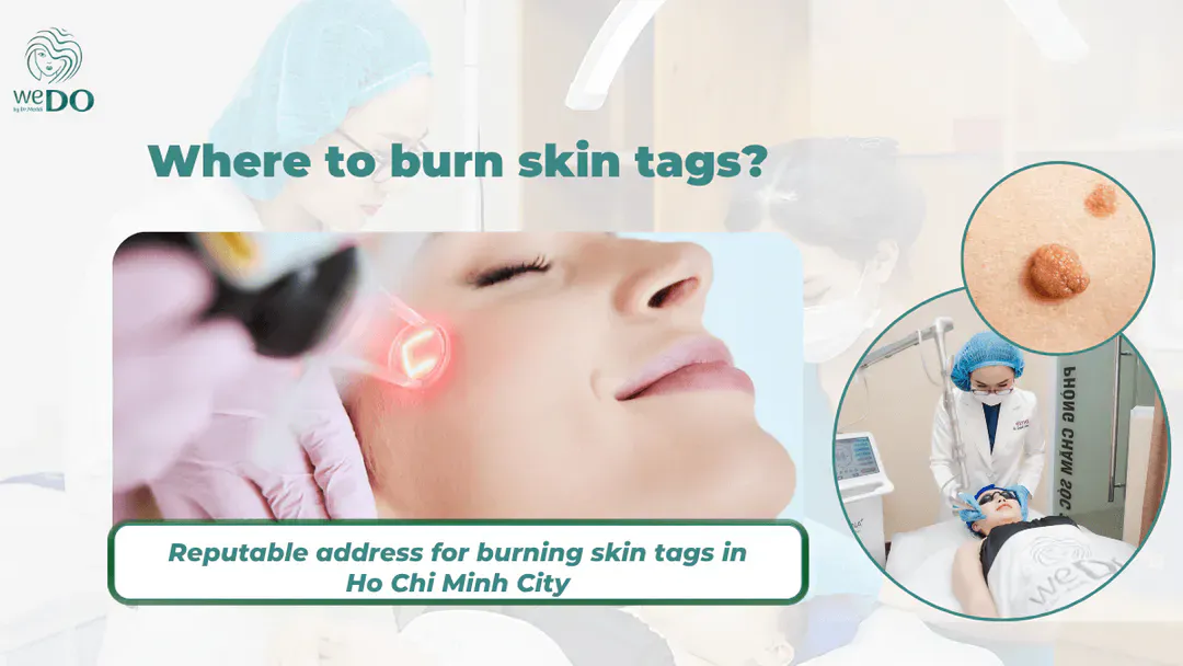Where to burn skin tags? Reputable address for burning skin tags in Ho Chi Minh City