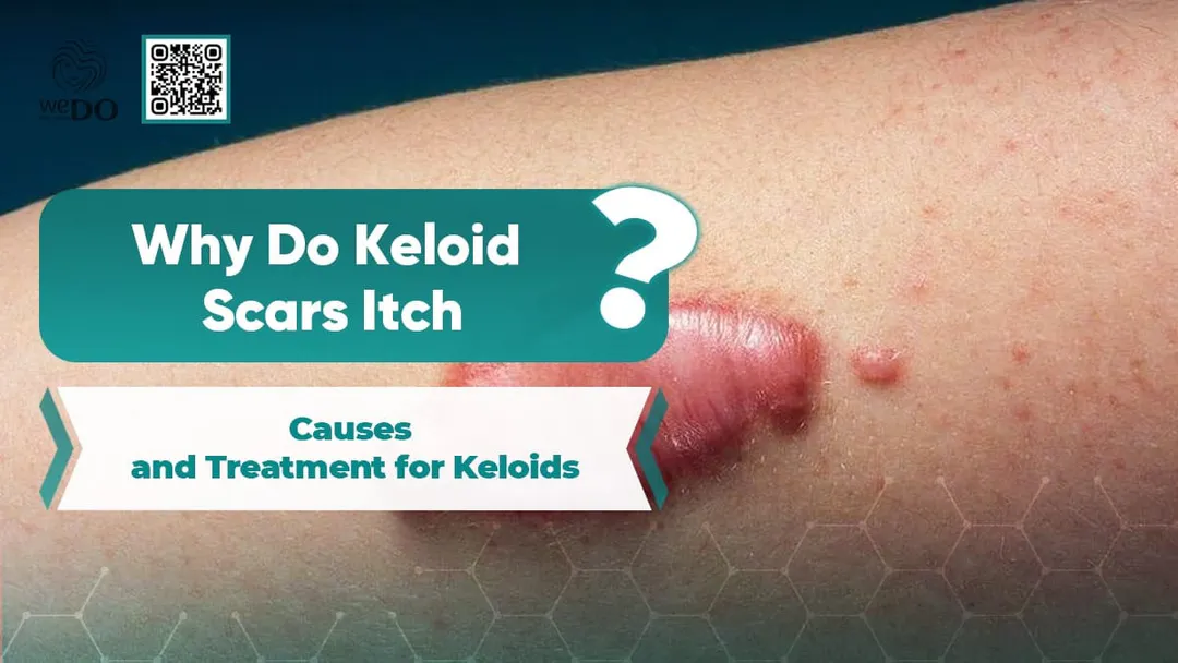 Why Do Keloid Scars Itch? Causes and Treatment for Keloids