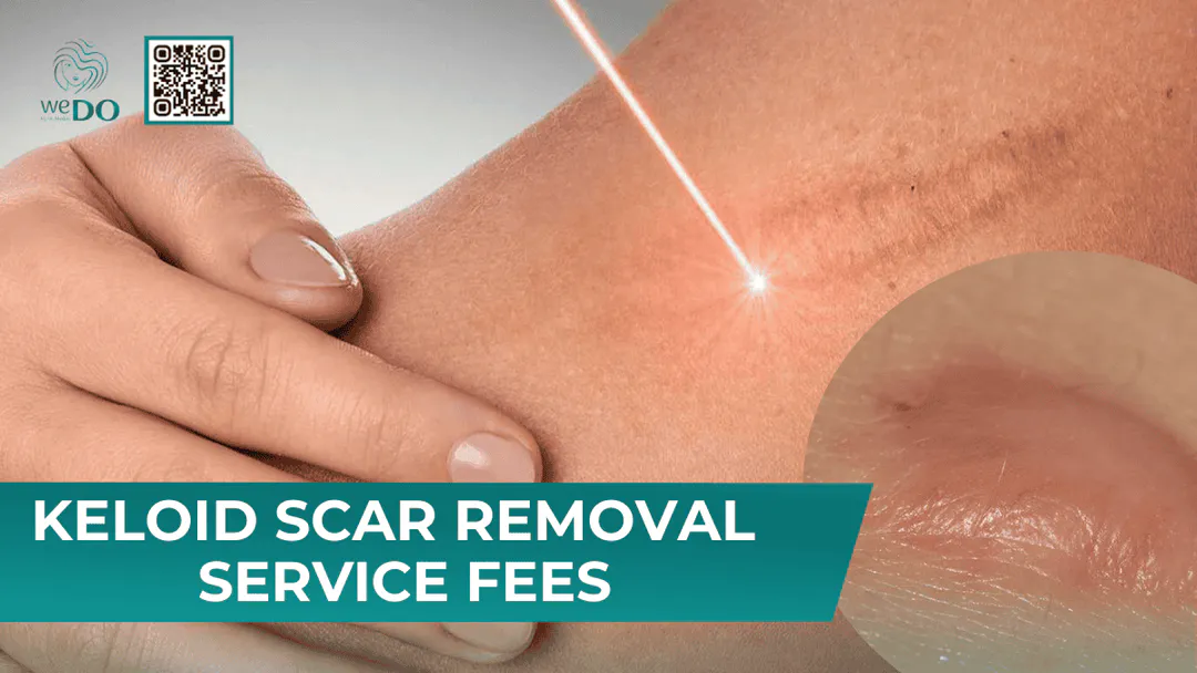 Keloid Scar Removal Service Fees