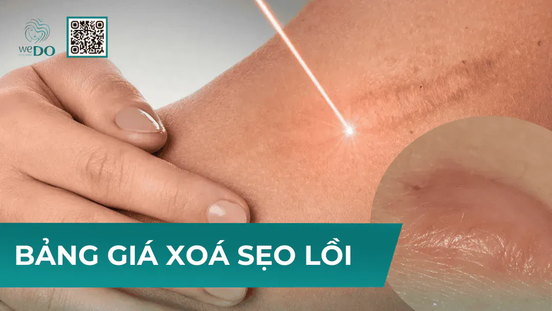 Xóa sẹo lồi giá bao nhiêu? Bảng giá trị sẹo lồi mới nhất 2026