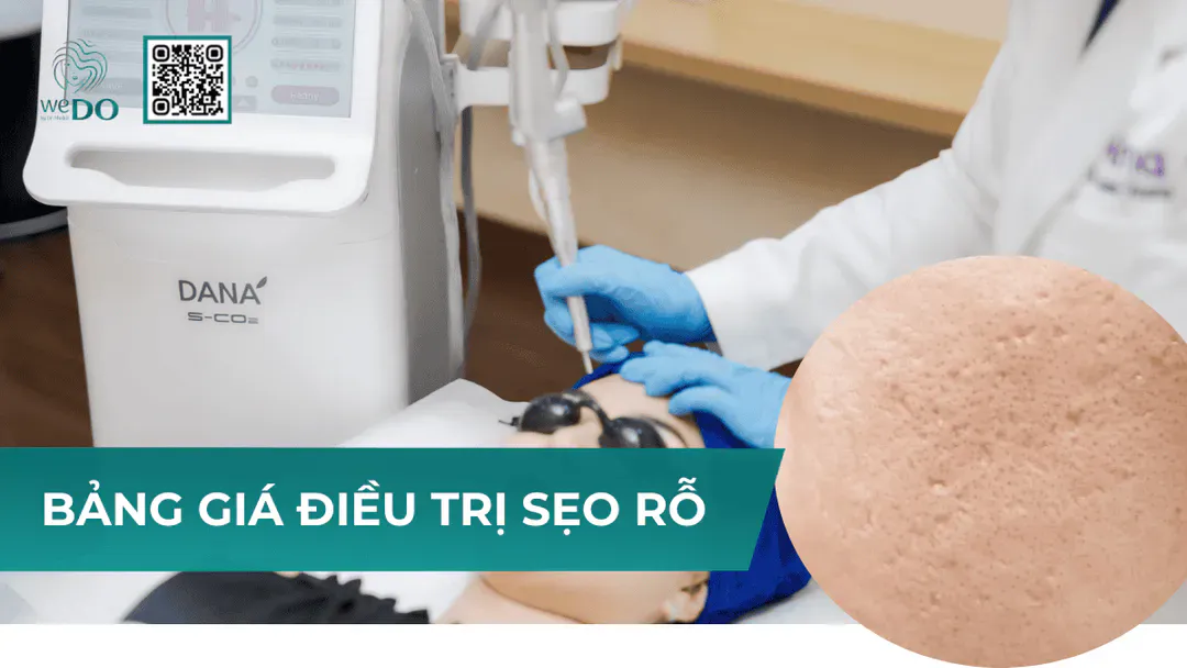 Trị sẹo rỗ hết bao nhiêu tiền? Bảng giá điều trị sẹo rỗ mới nhất