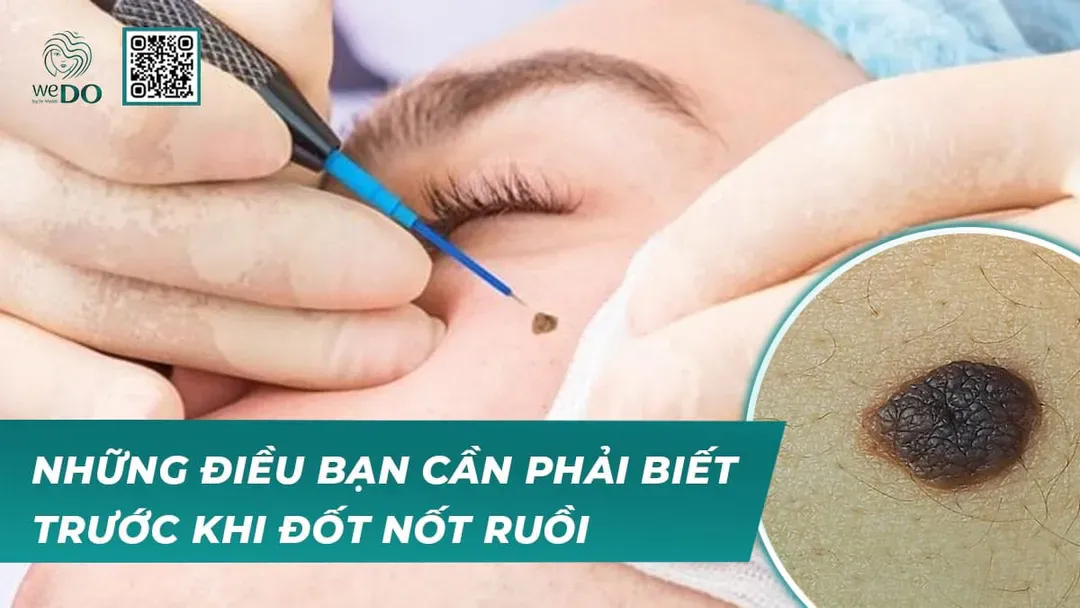 Những điều bạn cần phải biết trước khi đốt nốt ruồi