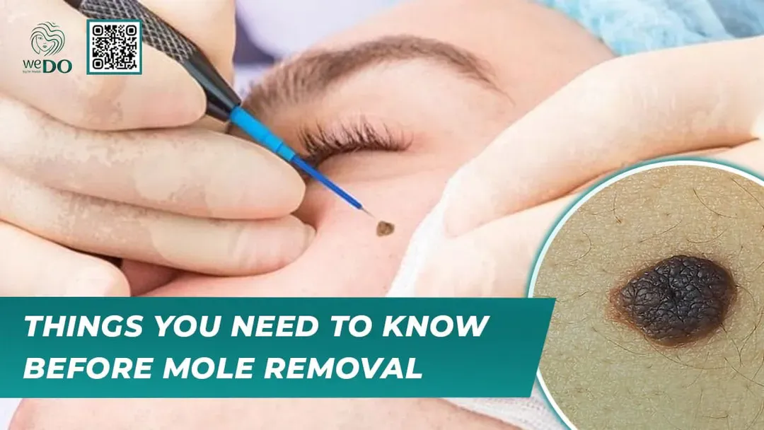 Things You Need to Know Before Mole Removal