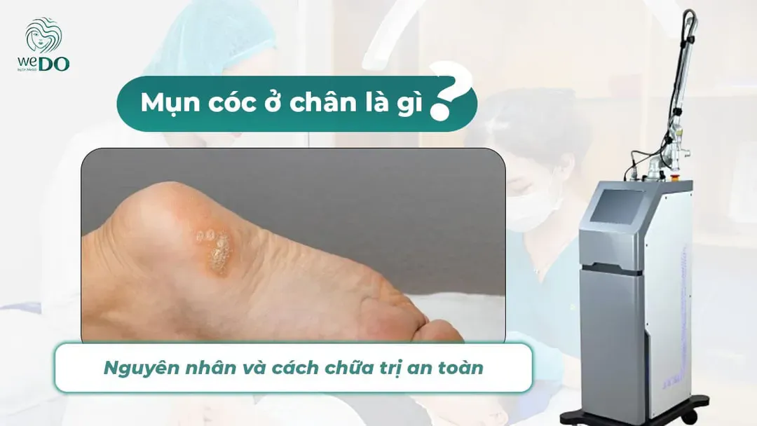 Mụn cóc ở chân là gì? Nguyên nhân và cách chữa trị an toàn