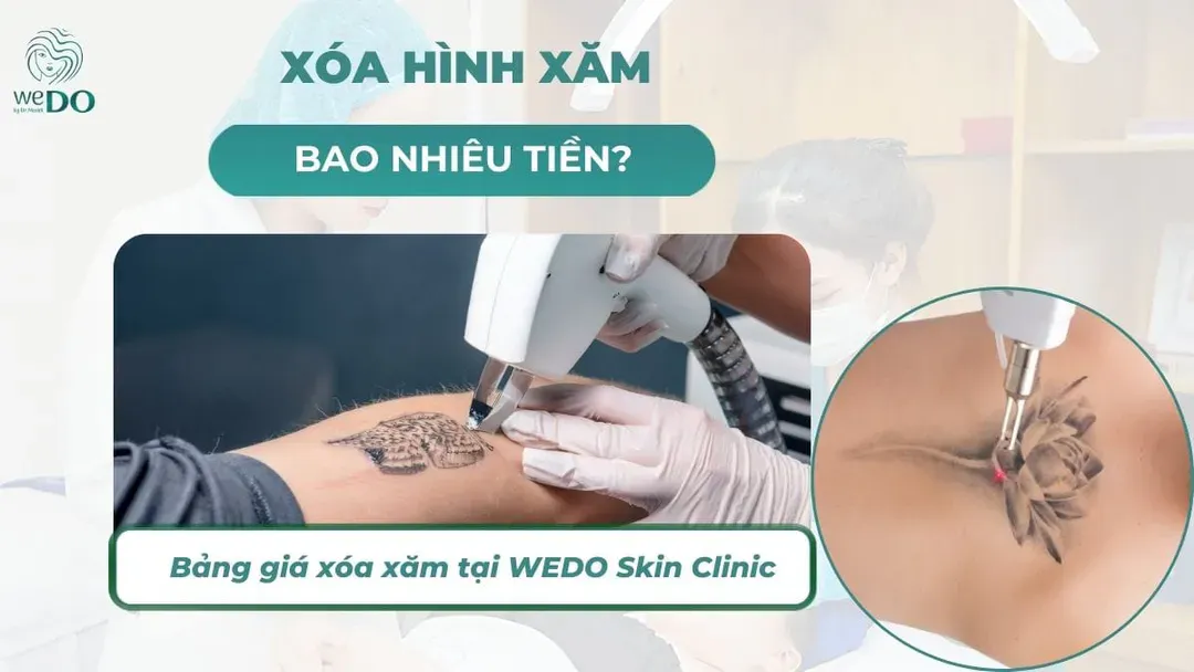 Xóa hình xăm bao nhiêu tiền? Bảng giá xóa hình xăm tại WEDO 2026