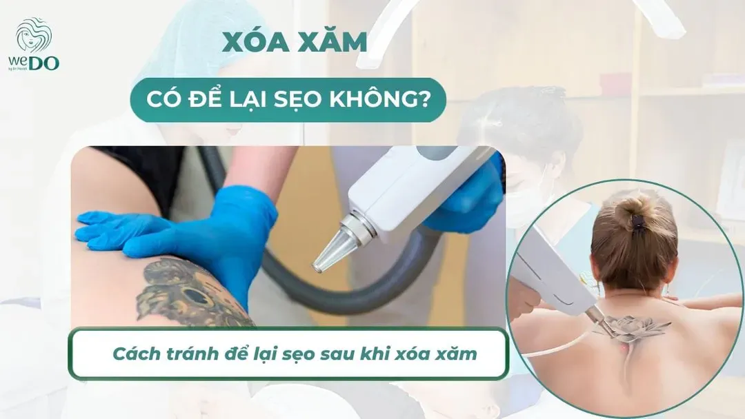 Xóa xăm có để lại sẹo không? Cách tránh để lại sẹo sau khi xóa xăm
