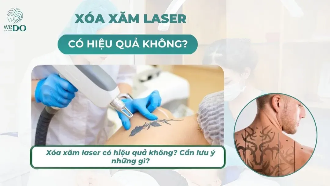 Xóa xăm laser có thật sự hiệu quả?