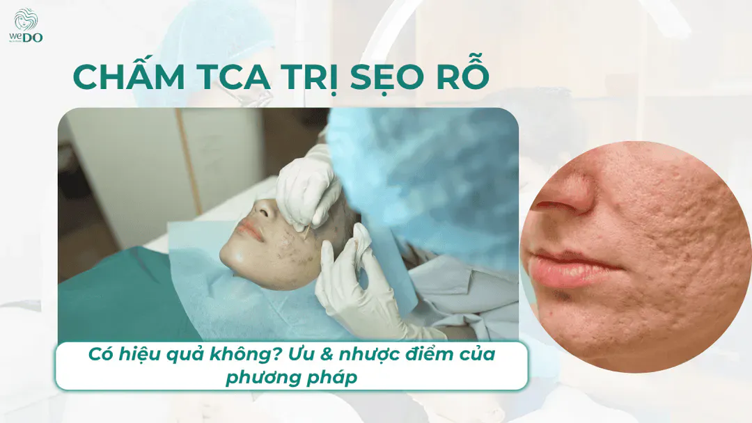 Chấm TCA trị sẹo rỗ có hiệu quả không?