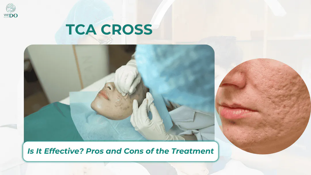 Is TCA CROSS effective for acne scars?
