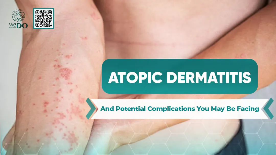 Atopic Dermatitis and Potential Complications You May Be Facing
