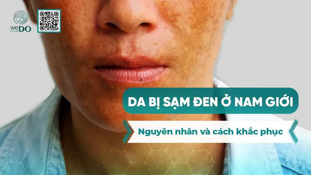 Da bị sạm đen ở nam giới – Nguyên nhân và cách khắc phục