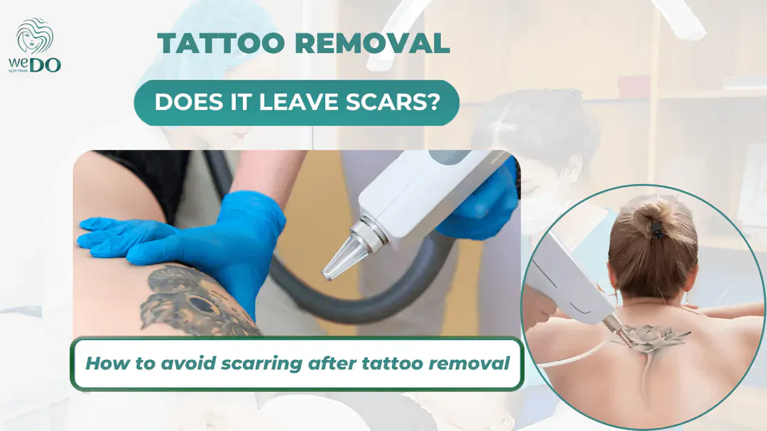 Does tattoo removal leave scars? How to avoid scarring after tattoo removal