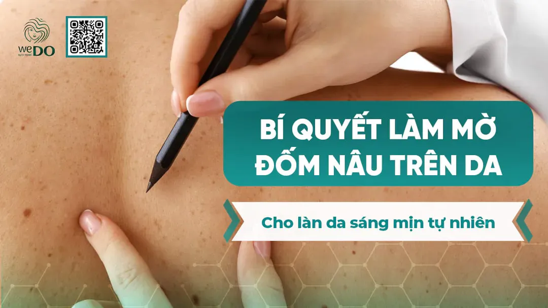 Bí quyết làm mờ đốm nâu trên da cho làn da sáng mịn tự nhiên