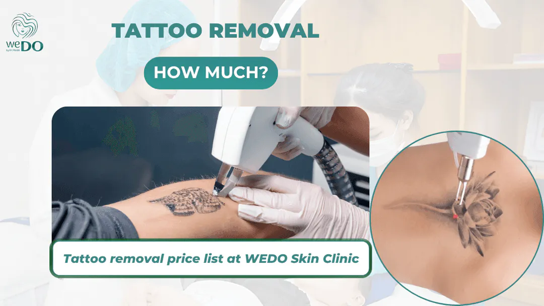 How much does it cost to remove a tattoo? Tattoo removal price list at WEDO 2026