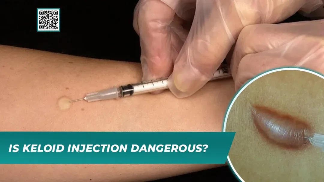 Is Keloid Injection Dangerous?