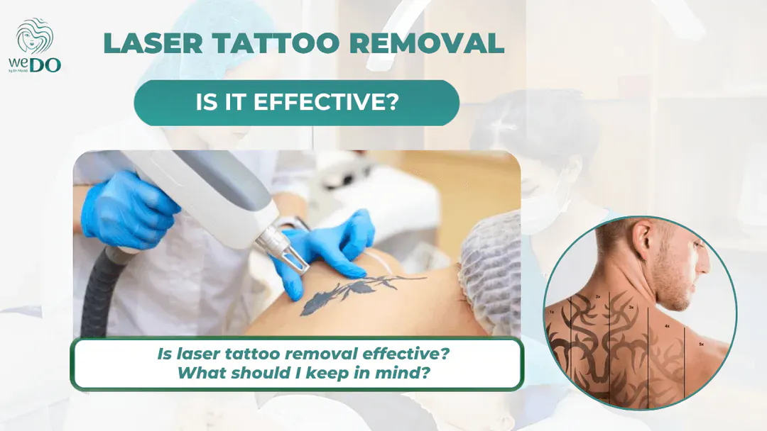 Is laser tattoo removal really effective?