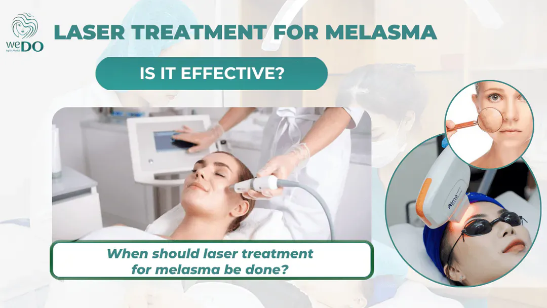 Is laser treatment for melasma effective? When should it be done?