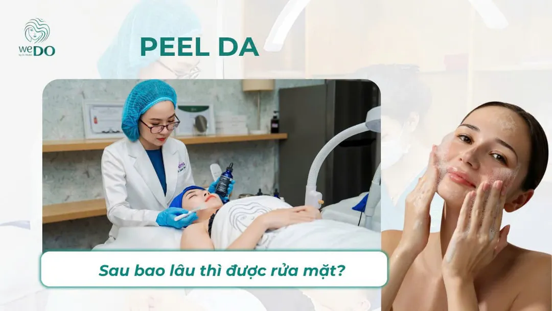 Sau peel da bao lâu thì rửa mặt bình thường? Kiêng nước bao lâu?