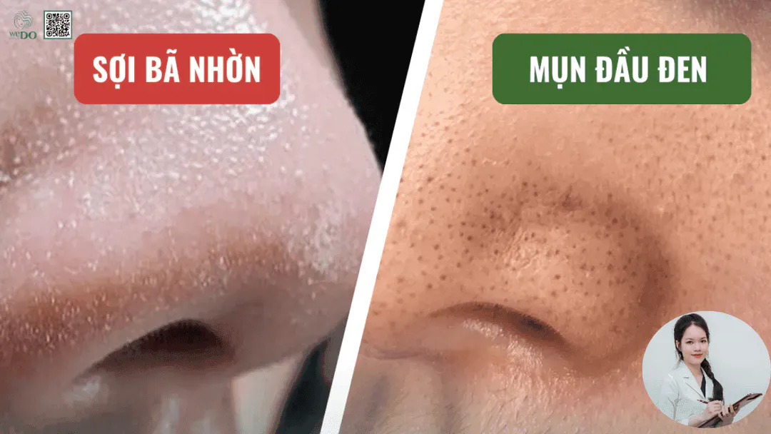 Cách phân biệt sợi bã nhờn và mụn đầu đen