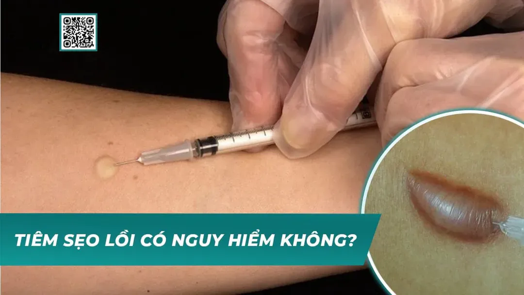 Điều trị sẹo lồi, sẹo phì đại: tiêm sẹo theo phác đồ bác sĩ