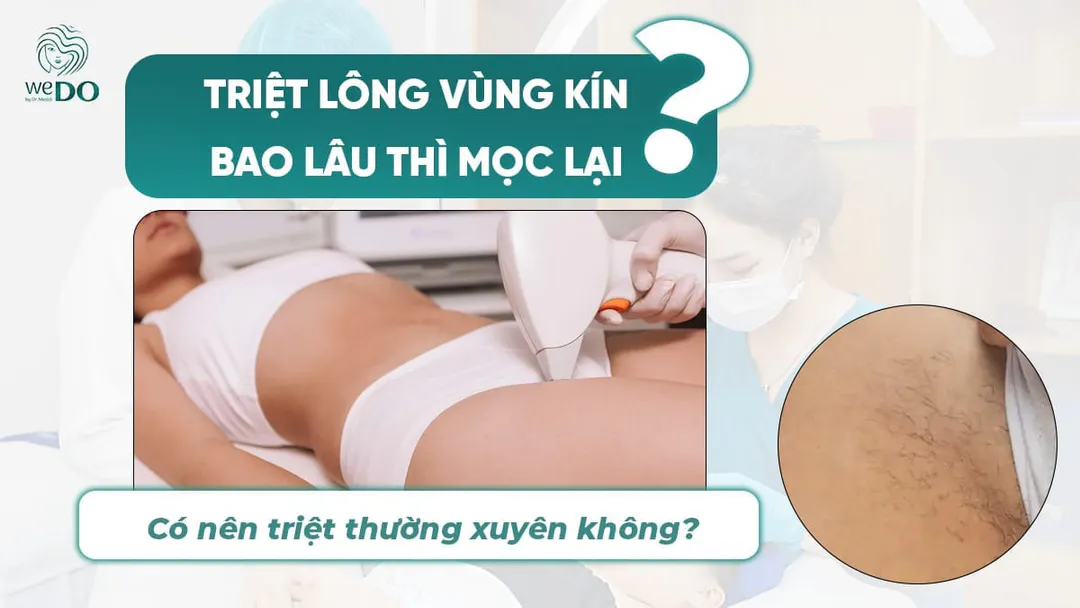 Triệt lông vùng kín bao lâu thì mọc lại và có nên triệt thường xuyên không?