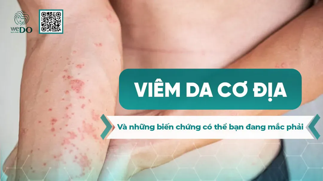 Viêm da cơ địa và những biến chứng có thể bạn đang mắc phải