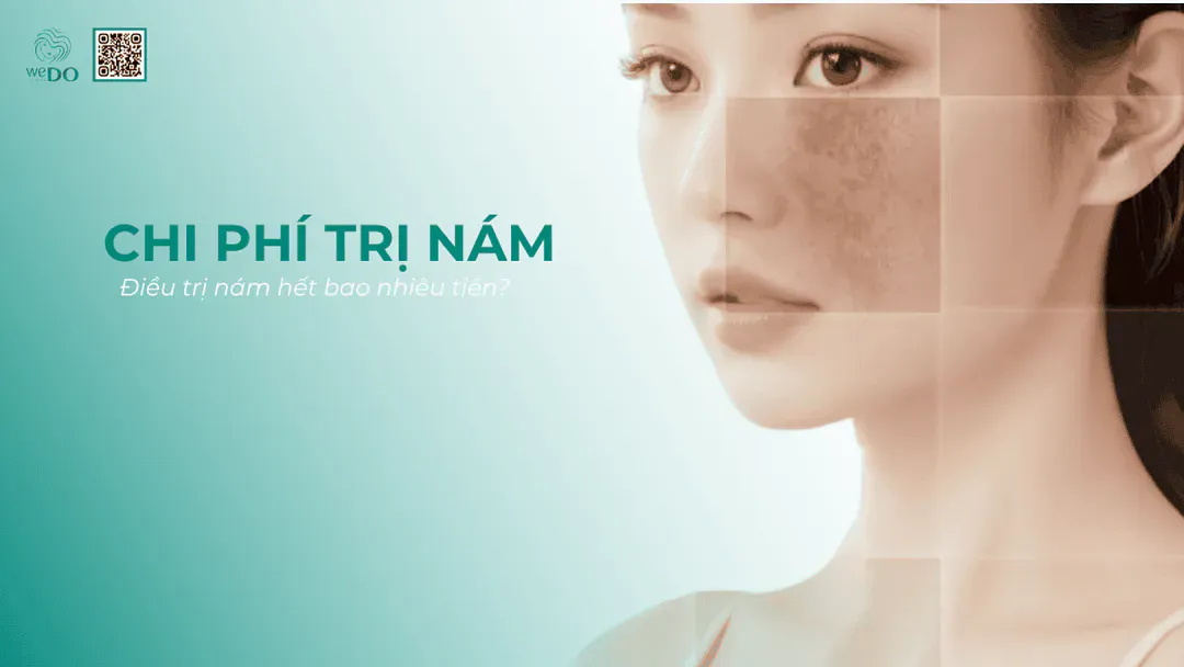Trị nám hết bao nhiêu tiền? Chí phí điều trị nám năm 2026