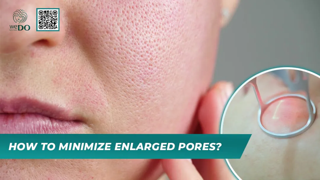 How to Minimize Enlarged Pores?