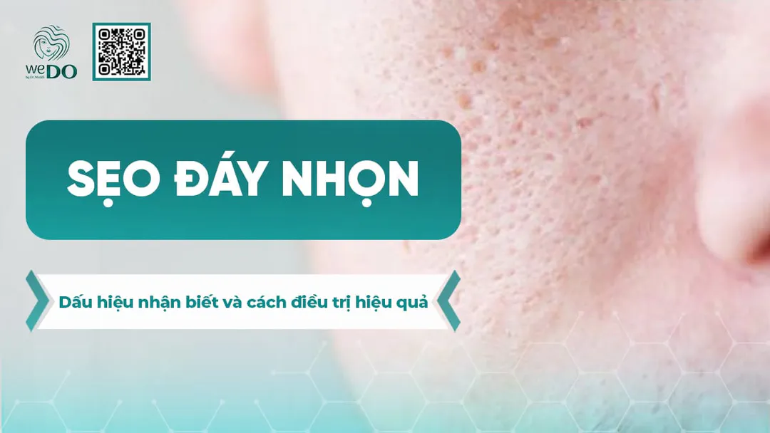 Sẹo đáy nhọn – Dấu hiệu nhận biết và cách điều trị hiệu quả