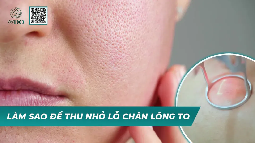 Làm sao để thu nhỏ lỗ chân lông to?