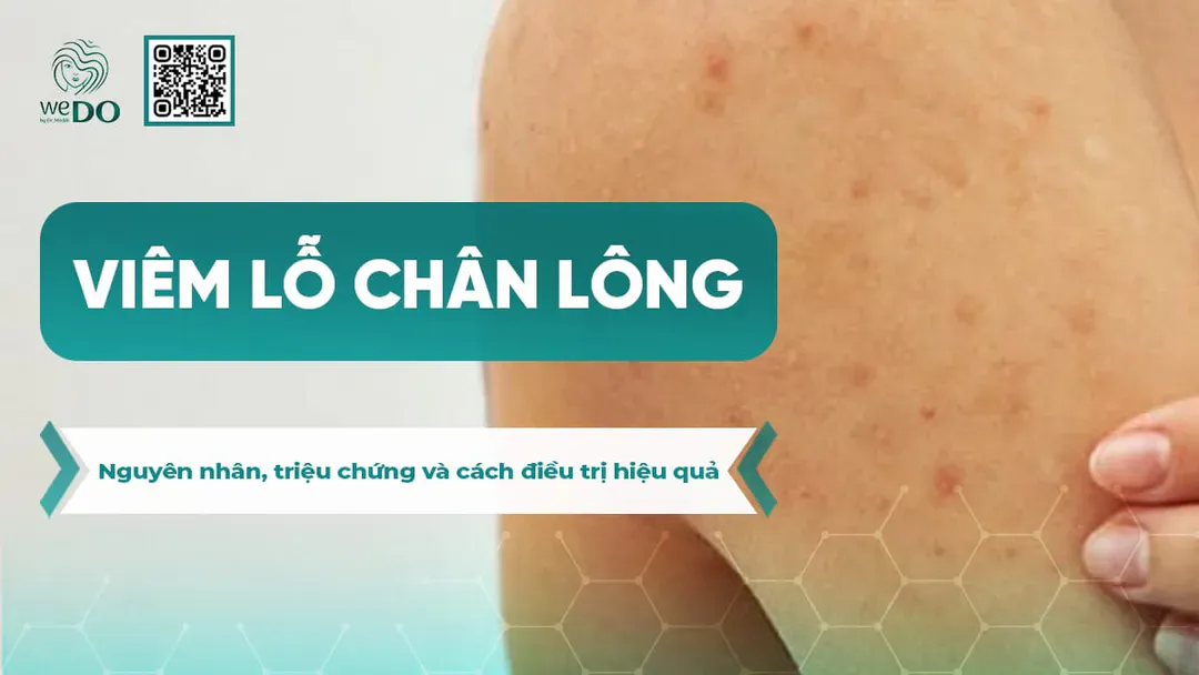 Viêm lỗ chân lông – Nguyên nhân, triệu chứng và cách điều trị hiệu quả