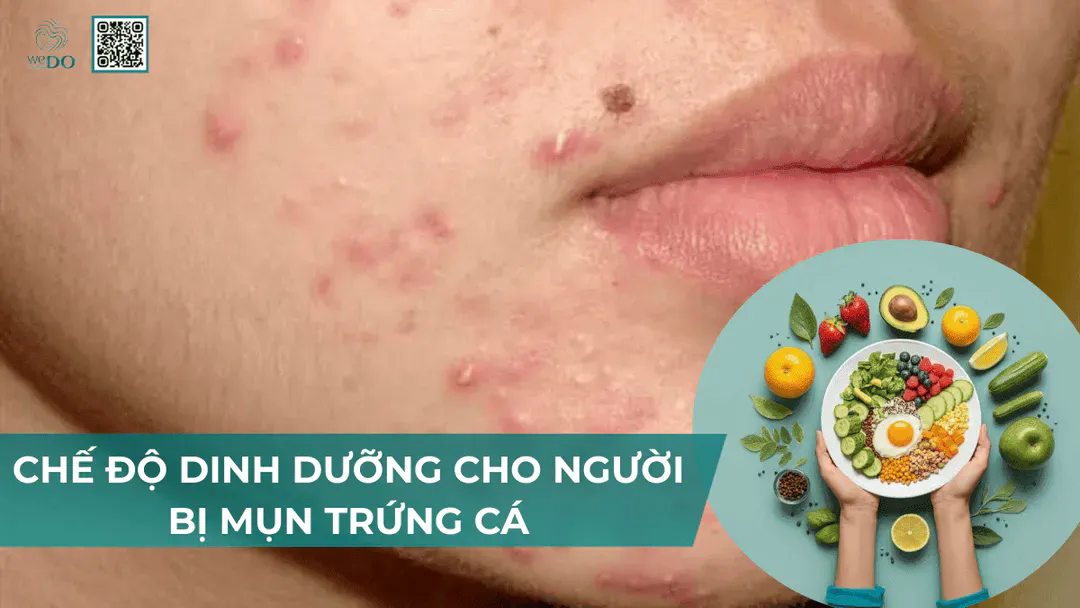 Chế độ ăn uống cho người bị mụn trứng cá
