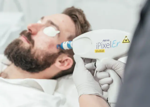 Laser Erbium trị sẹo và thu nhỏ lỗ chân lông