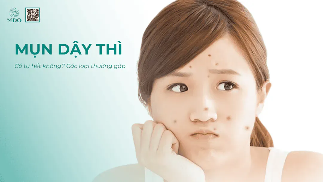 Nhận biết các loại mụn thường gặp ở tuổi dậy thì