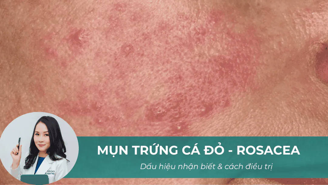 Rosacea là bệnh gì? Dấu hiệu nhận biết và cách điều trị chứng mặt đỏ