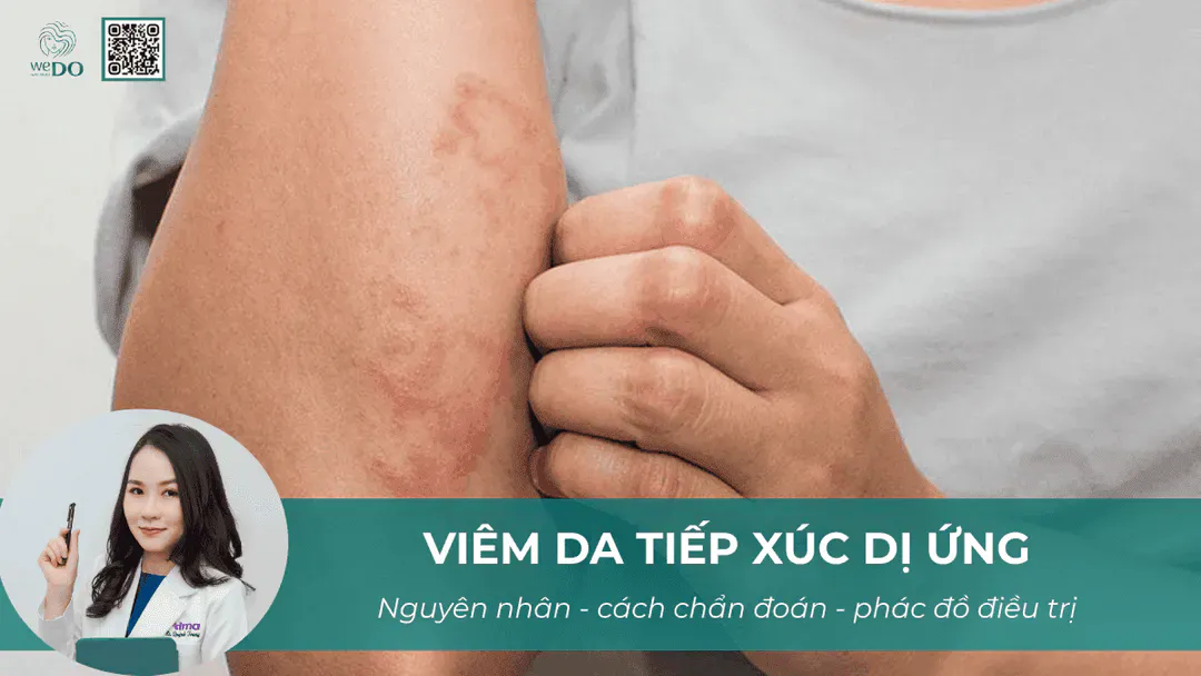 Viêm da tiếp xúc dị ứng – Nguyên nhân, cách chẩn đoán và phác đồ điều trị