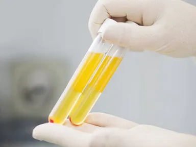 Về PRP (huyết tương giàu tiểu cầu)