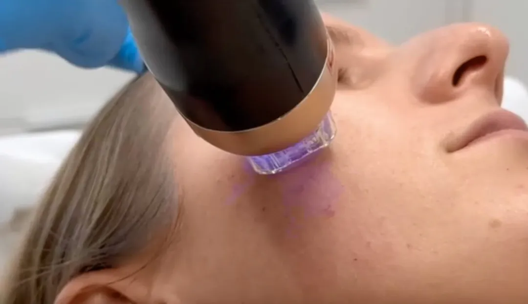 Mechanism of Action of RF Needling