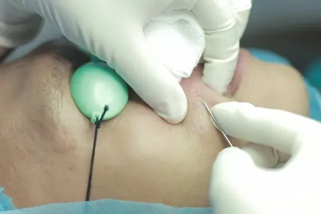 Bóc tách đáy sẹo (Subcision)
