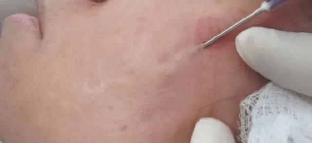 Suitable Candidates for Subcision Treatment