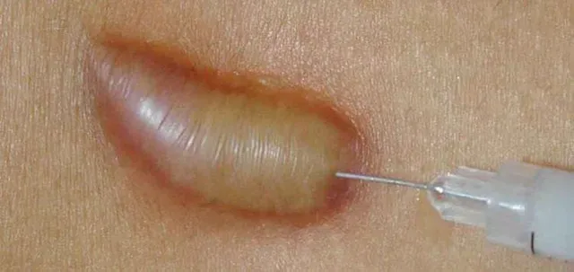 Efficacy of Keloid Injection