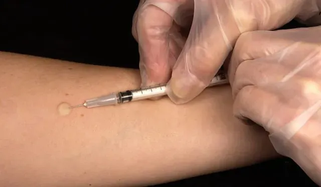 Scar injection